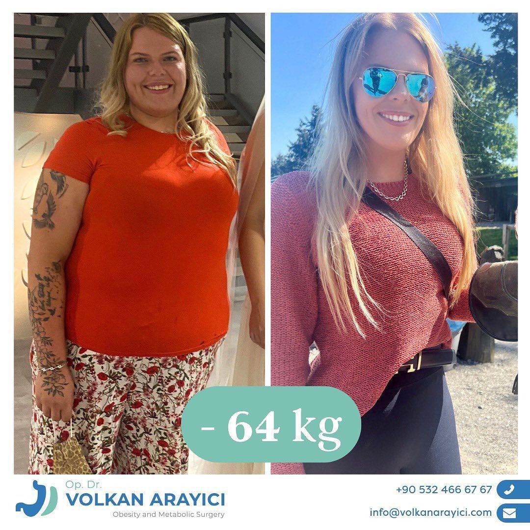 Magenverkleinerung Türkei